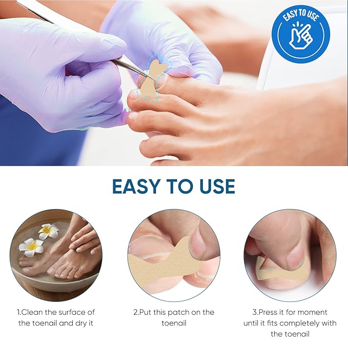 Ingrown Toenail Treatment, 60Pcs Ingrown Toenail Corrector Strips, Ingrown Toenail Removal Kit with File and Lifter, 60Pcs
