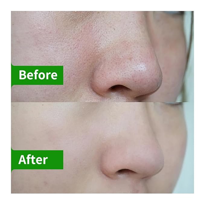 Blackhead Remover 3-in-1 Kit with Pore Strips, 10ml Blackhead Removal Liquid and 10ml Pore Shrinking Essence, Facial Care Set for Nose & T-Zone, Gentle for All Skin Types