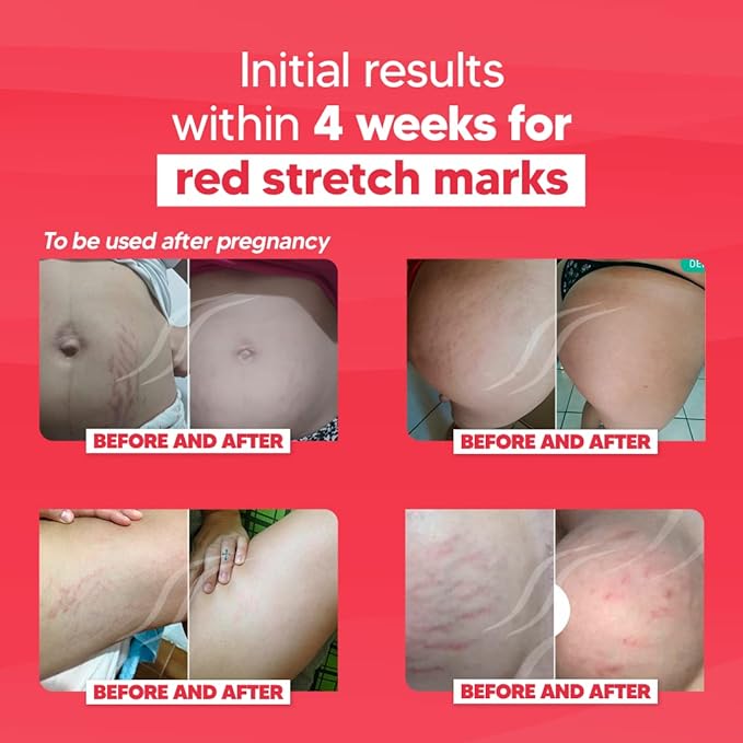 Cicatrissim Red For Removal of Red and Purple Stretch Marks - Innovative Formula With Pure and Powerful Natural Ingredients From Brazilian Flora - For All Skin Types.