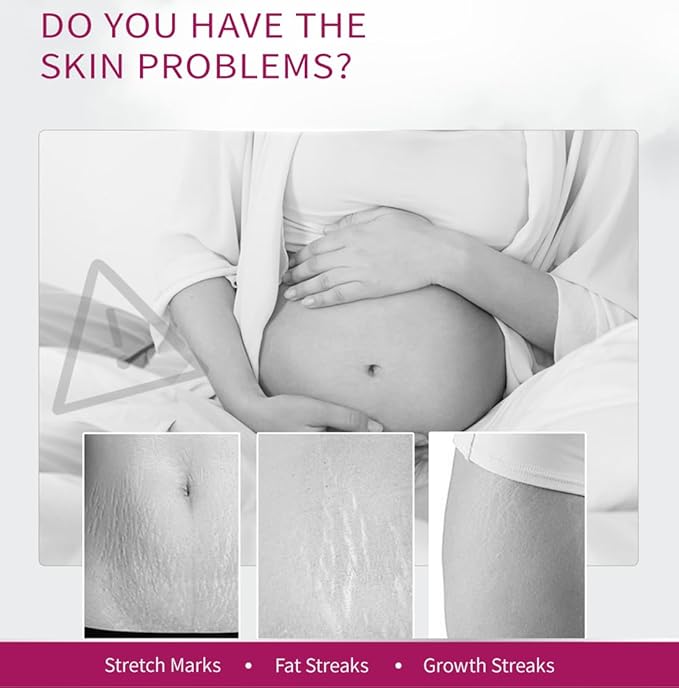 Stretch Mark Removal Cream, Obesity Stretch Mark Moisturizer, Postpartum Repair Stretch Mark Cream, Abdominal Stretch Mark Cream, Remove Marks (1 PCS)