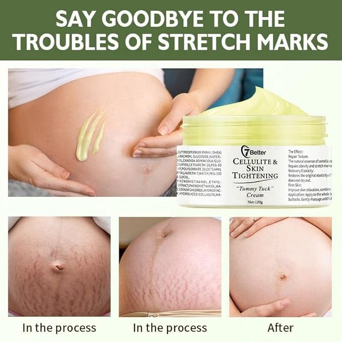Stretch Marks and Scars Removal Cream for Pregnancy - Scars Repair, Abdominal Firming, and Gentle Stretch Marks Eradication Skincare Body