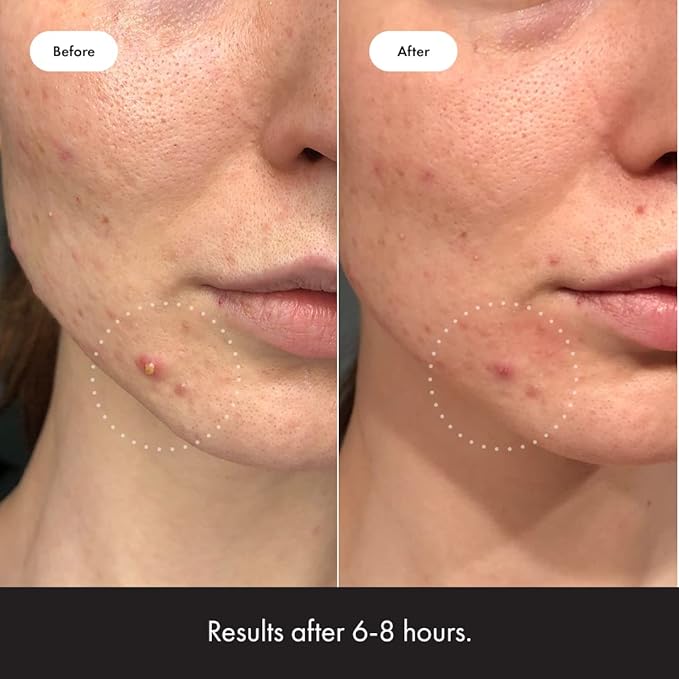 Mighty Patch™ Invisible+ Patch - Daytime Hydrocolloid Acne Pimple Patches for Covering Zits and Blemishes, Ultra Thin Spot Stickers for Face and Skin (24 Medium and 15 Small Patches)