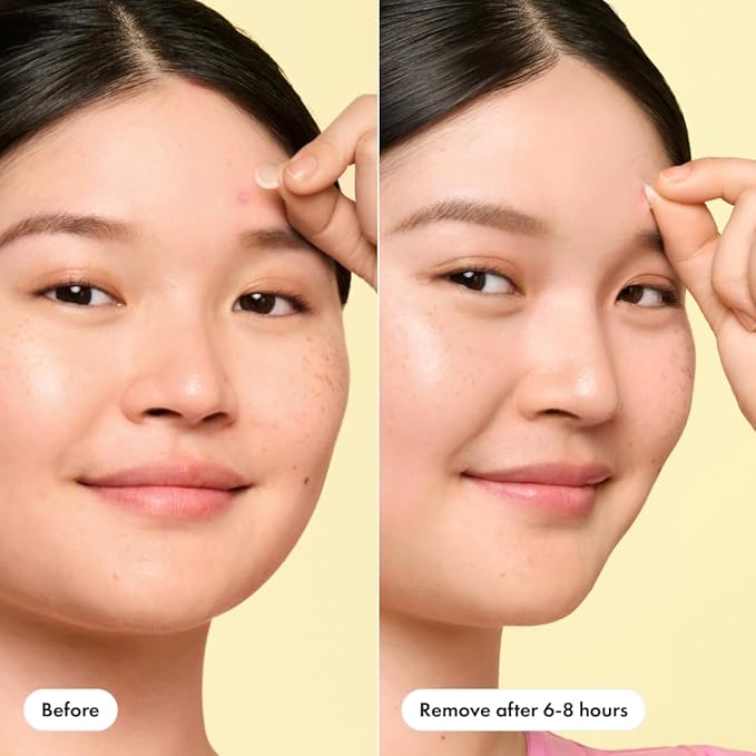 Mighty Patch Mini Invisible+ Patches - X-Small Daytime Hydrocolloid Acne Pimple Patches for Covering Zits & Blemishes, Blends Into Skin & Barely There (30 Count, 10mm Patch)