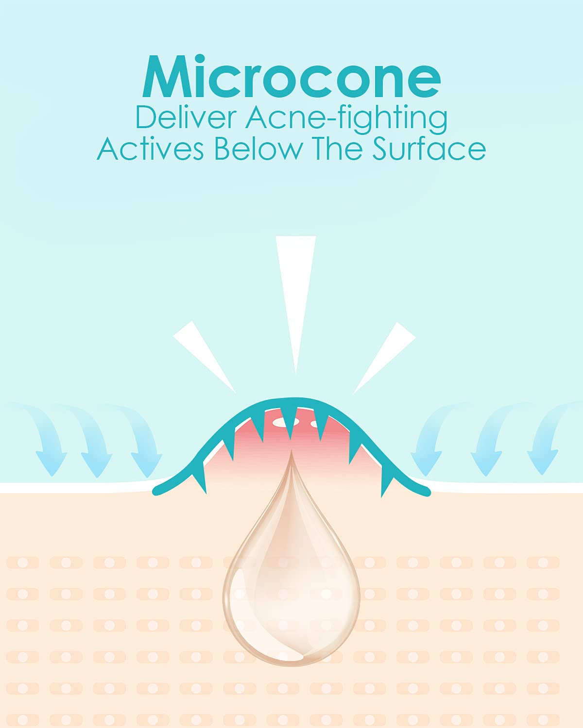 Microdart Acne Patch (18 Patches) - Hyaluronate Acid & Salicylic Acid Hydrocolloid Pimple Patch for Deep, Early and Hidden Blemishes (18 Count (Pack of 1))