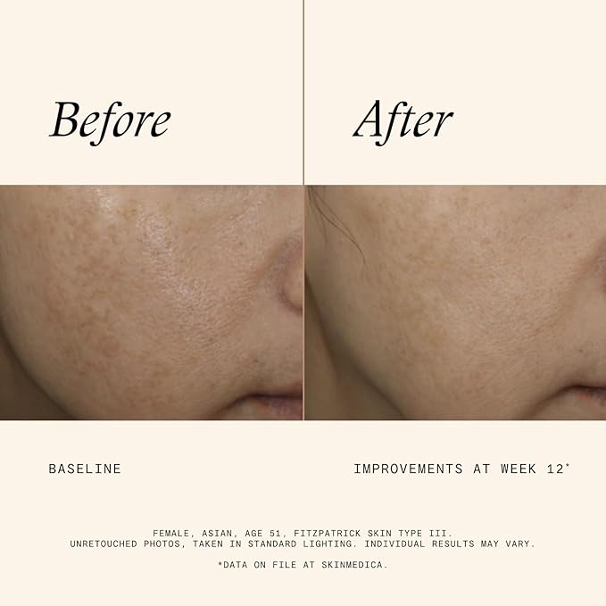 SkinMedica Even & Correct Advanced Brightening Treatment Face Serum (NEW PACKAGING), Addresses the Appearance of Dark Spots, Hyperpigmentation & Melasma for Aging Skin,1.7 Fl Oz