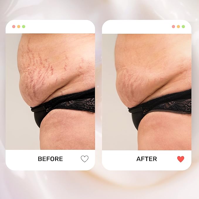 S1 Stretch Mark Cream, 150ml / 5oz, Lightweight Pregnancy Stretch Mark Cream