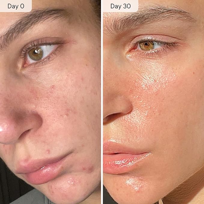 Qure Micro Infusion System for Face & Neck - Facial Moisturizing Essence, Hydrating Serum for All Skin Types, Refreshed Skin - 3-Month Supply