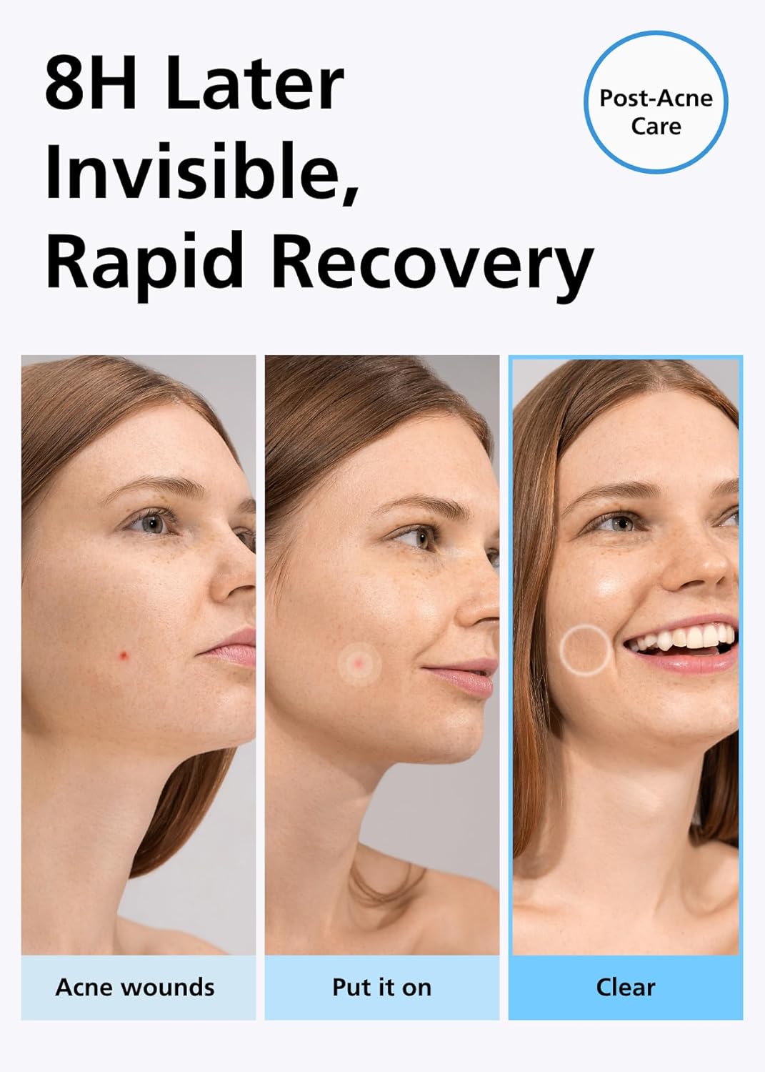 EasyDerm Beauty Patch(84 Counts) - 100% Hydrocolloid Pimple Patch for Zit Spot Care, K-beauty, Daewoong Pharmaceutical, Korean Acne Patches