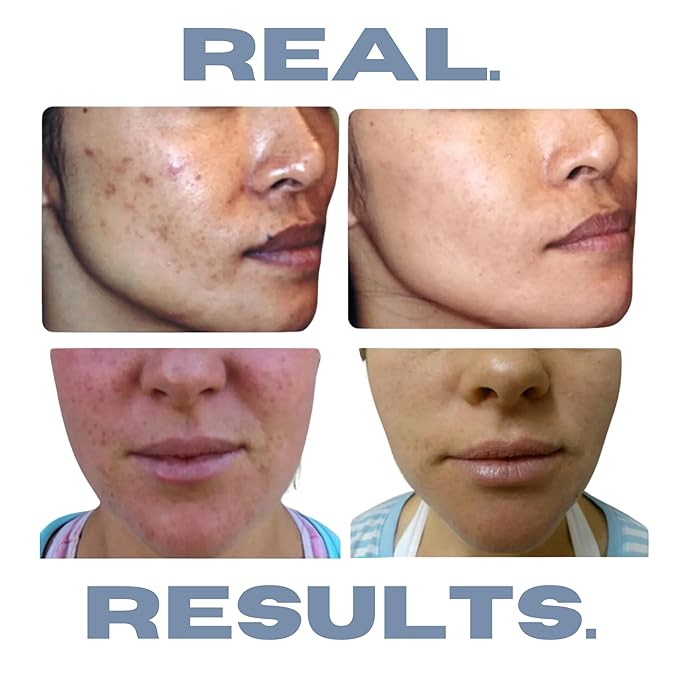 Clarifying Toner for Acne and Blemishes, Face Toner, Facial Toner, Skin Toner, Acne Toner, Toner Oily Skin, Salicylic Acid Toner, Astringent for Face, Toners, 4 Fl Oz