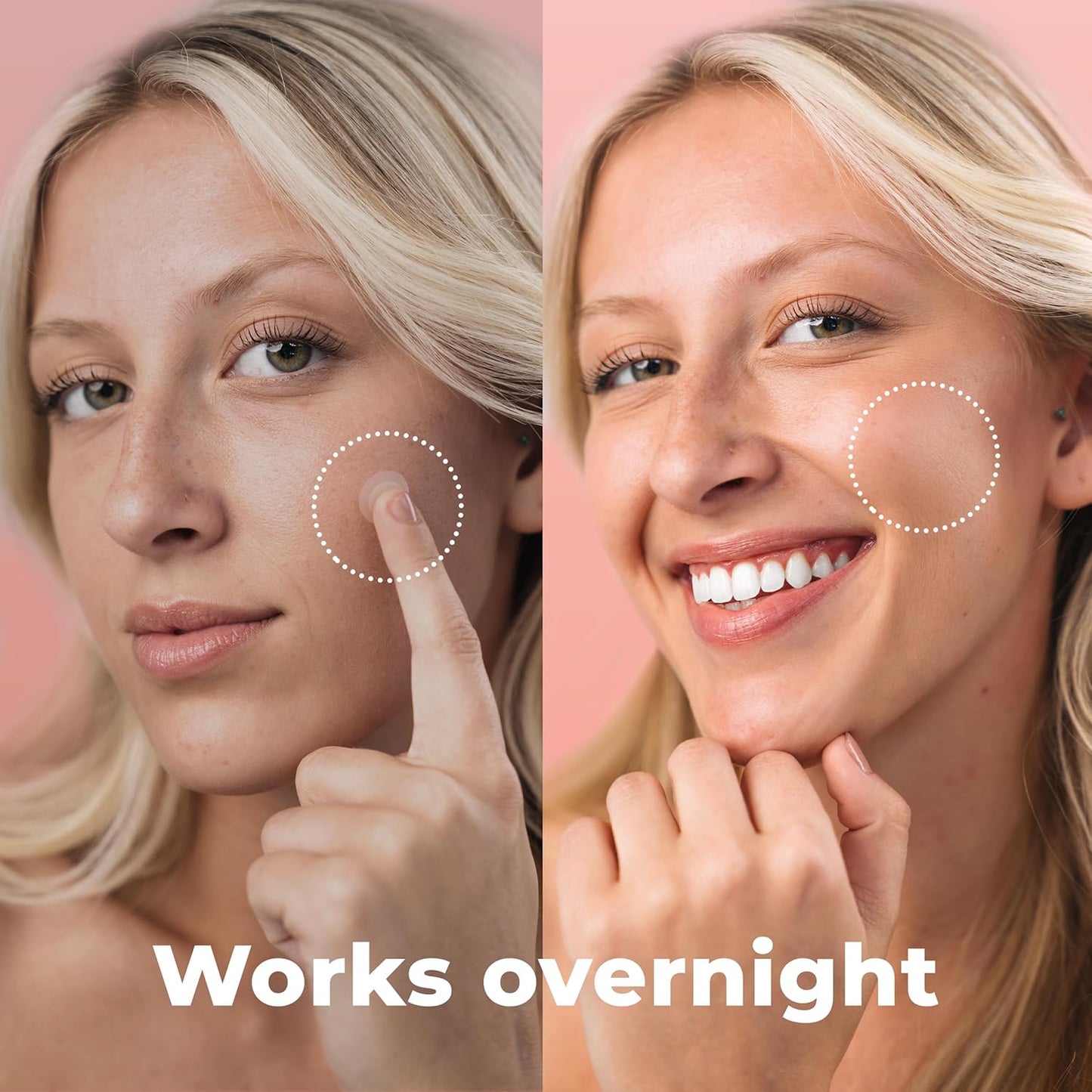 Micro Needle Pimple Patch (18 Pack) - Hydrocolloid Micropoint Pimple Patch For Acne & Pimples, Eliminate Pimples Overnight, Microdart Patch, Micro Dart Pimple Patches