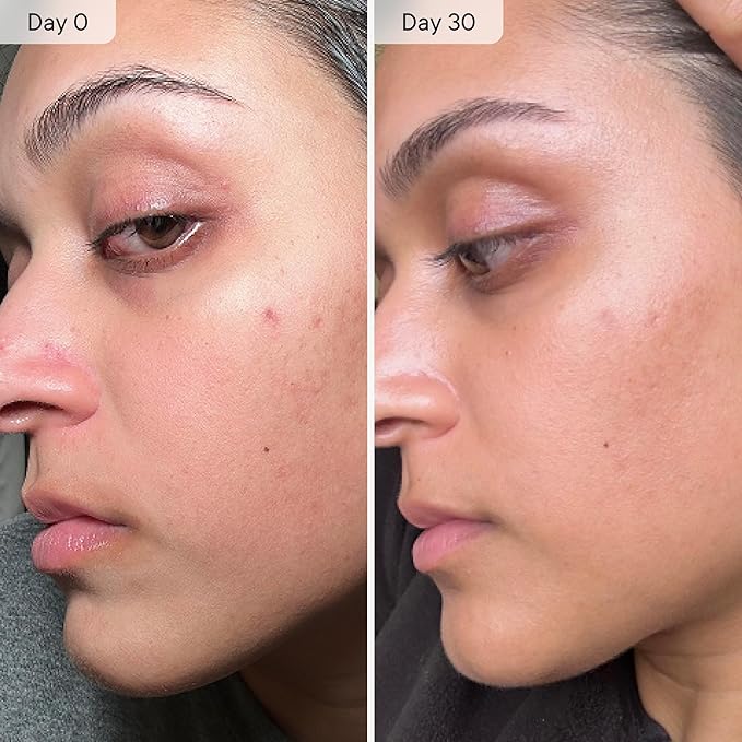 Qure Micro Infusion System for Face & Neck - Facial Moisturizing Essence, Hydrating Serum for All Skin Types, Refreshed Skin - 1-Month Supply