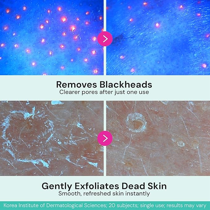 BIVID In & Out Bio-Cellulose Sheet Mask, Hydrating Korean Skincare Face Mask for Pore Care, Sebum & Blackhead Care with Tea Tree — K-Beauty Self Care Facial Skin Care Essentials, 0.88 oz, 5 Pack