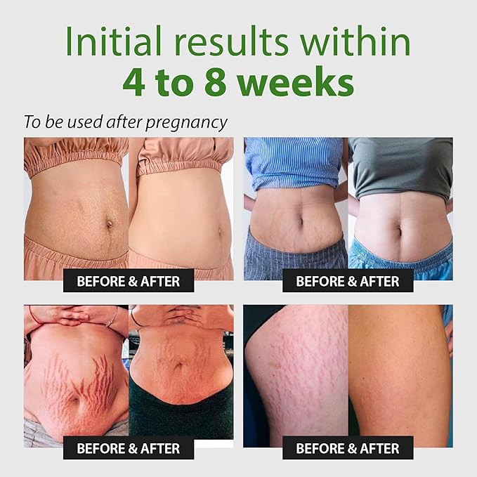Abera Ovela Maternity Stretch Mark Cream for Pregnancy and Weight Fluctuations, Stretch Mark Treatment Pregnancy Must Haves, Deep Stretch Mark Removal, All Skin Types, 1.69 fl oz, Set of 3